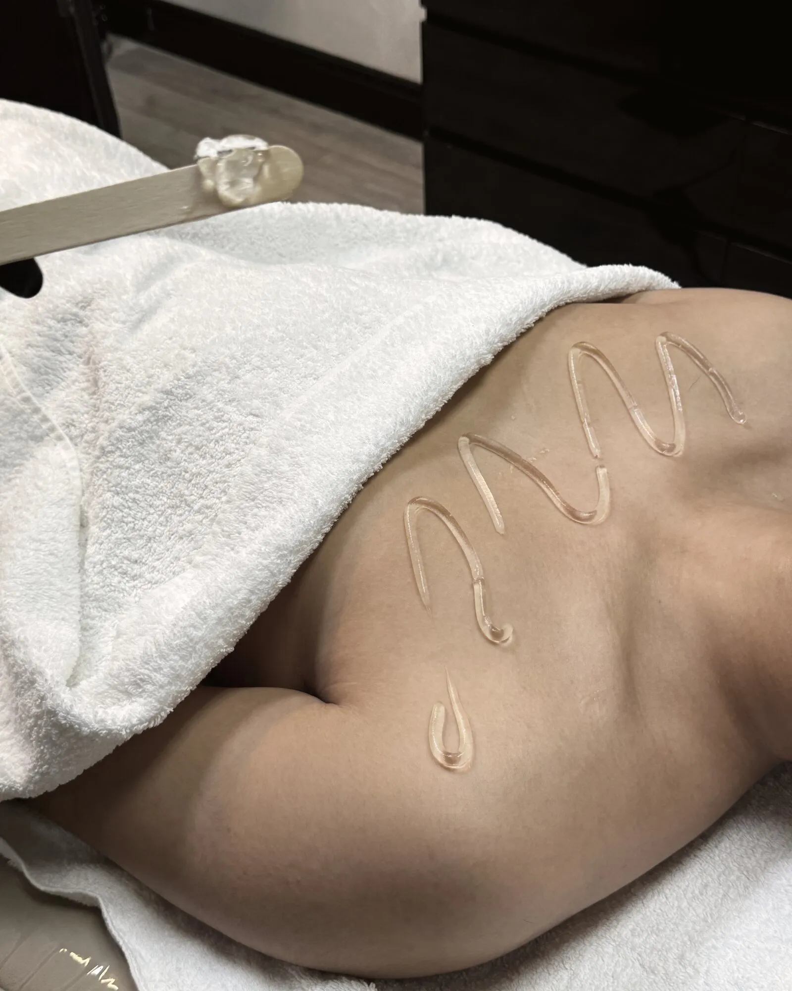 Cold gel drawn across a man's back before laser