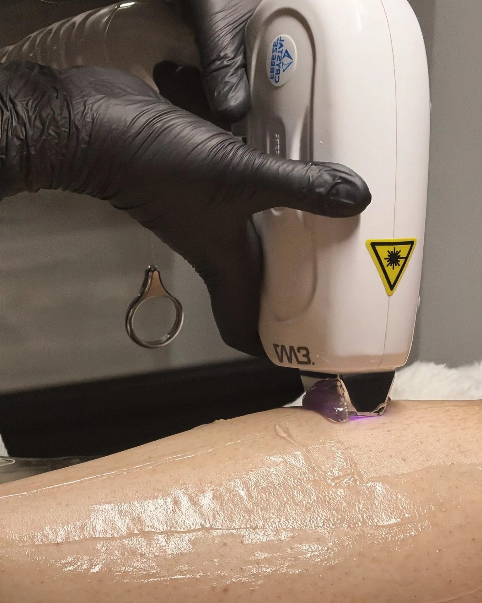 The chilled laser tip on a leg, over cold gel